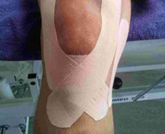 Kinesio Taping